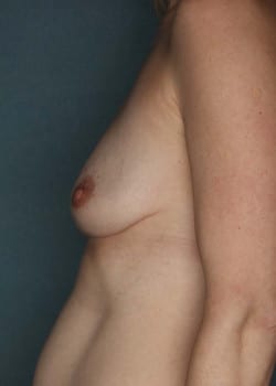 Bilateral Breast Augmentation