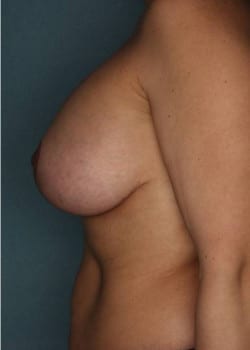 Bilateral Breast Lift & Augmentation