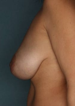 Bilateral Breast Lift & Augmentation