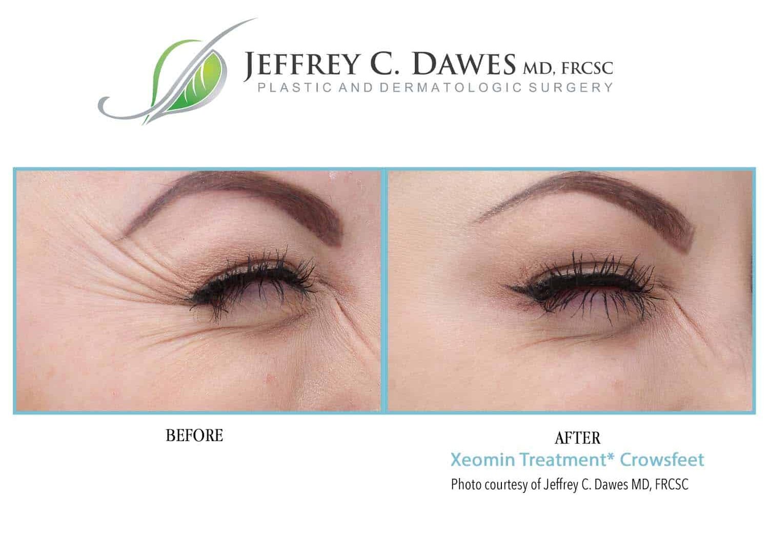 Before: "Pre-Xeomin treatment image showing facial expression lines and wrinkles." After: "Post-Xeomin treatment image displaying reduced facial lines and smoother skin at Jeffrey C. Dawes clinic in Calgary, Alberta.